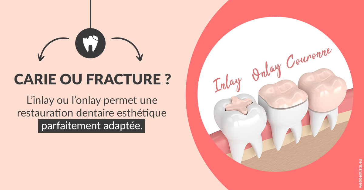 https://dr-renger-stephane.chirurgiens-dentistes.fr/T2 2023 - Carie ou fracture 2