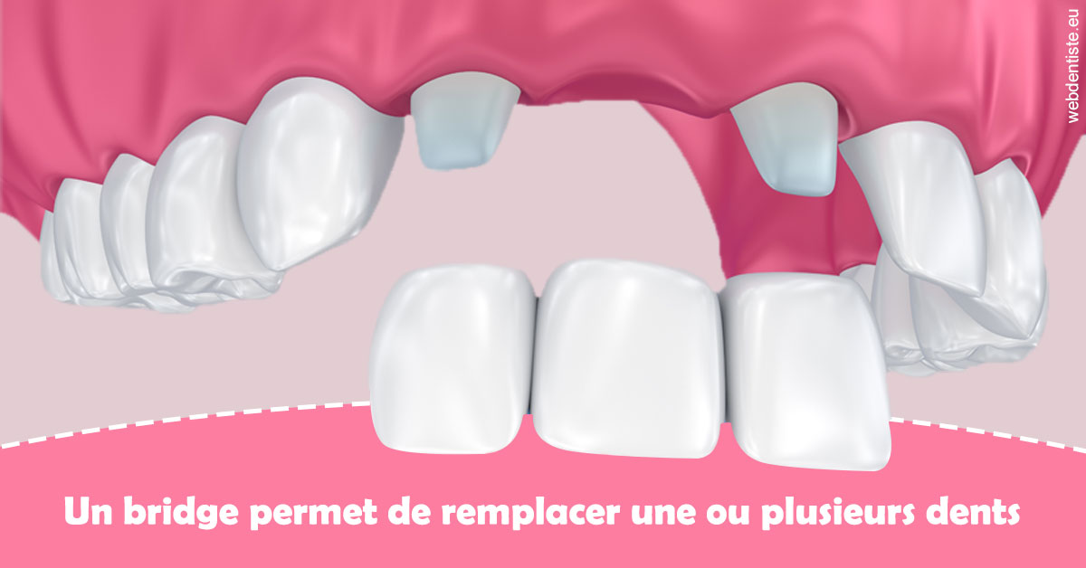 https://dr-renger-stephane.chirurgiens-dentistes.fr/Bridge remplacer dents 2