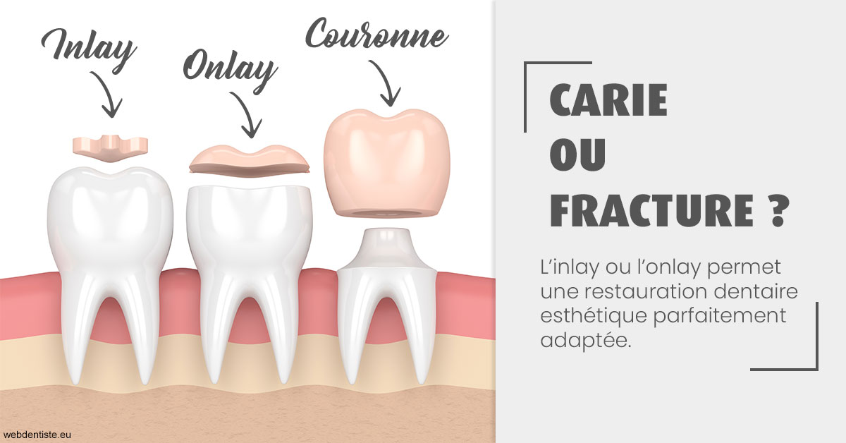 https://dr-renger-stephane.chirurgiens-dentistes.fr/T2 2023 - Carie ou fracture 1