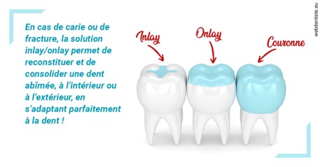 https://dr-renger-stephane.chirurgiens-dentistes.fr/L'INLAY ou l'ONLAY