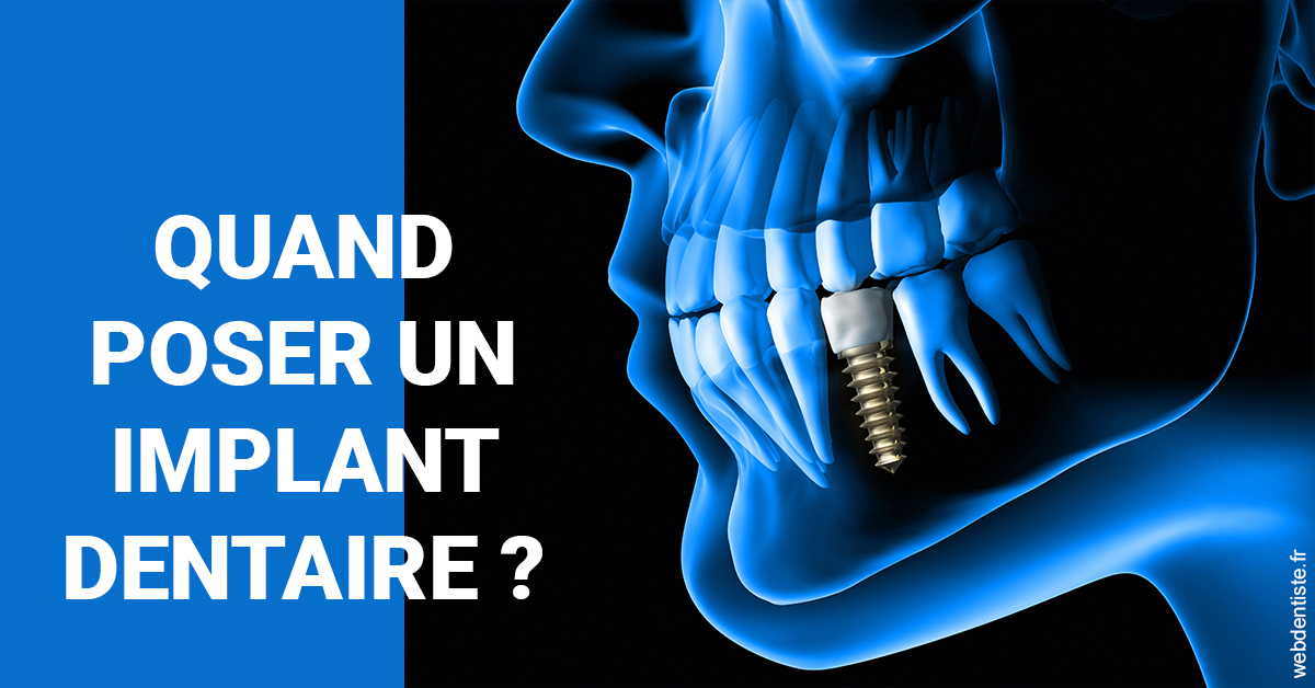 https://dr-renger-stephane.chirurgiens-dentistes.fr/Les implants 1