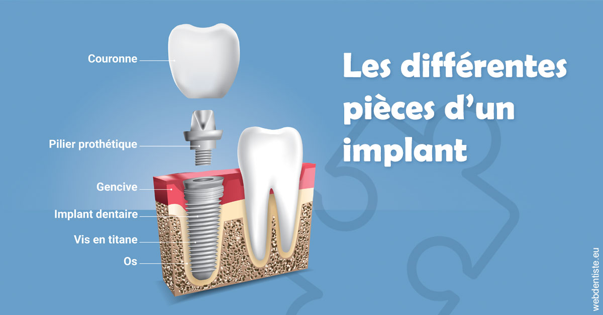 https://dr-renger-stephane.chirurgiens-dentistes.fr/Les différentes pièces d’un implant 1