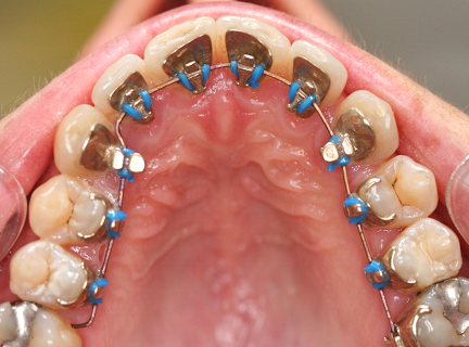 orthodontie_linguale_bouche