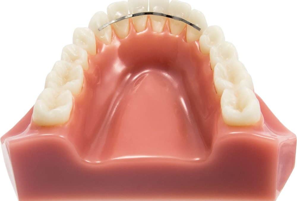 fil-de-contention-en-orthodontie-1000x675
